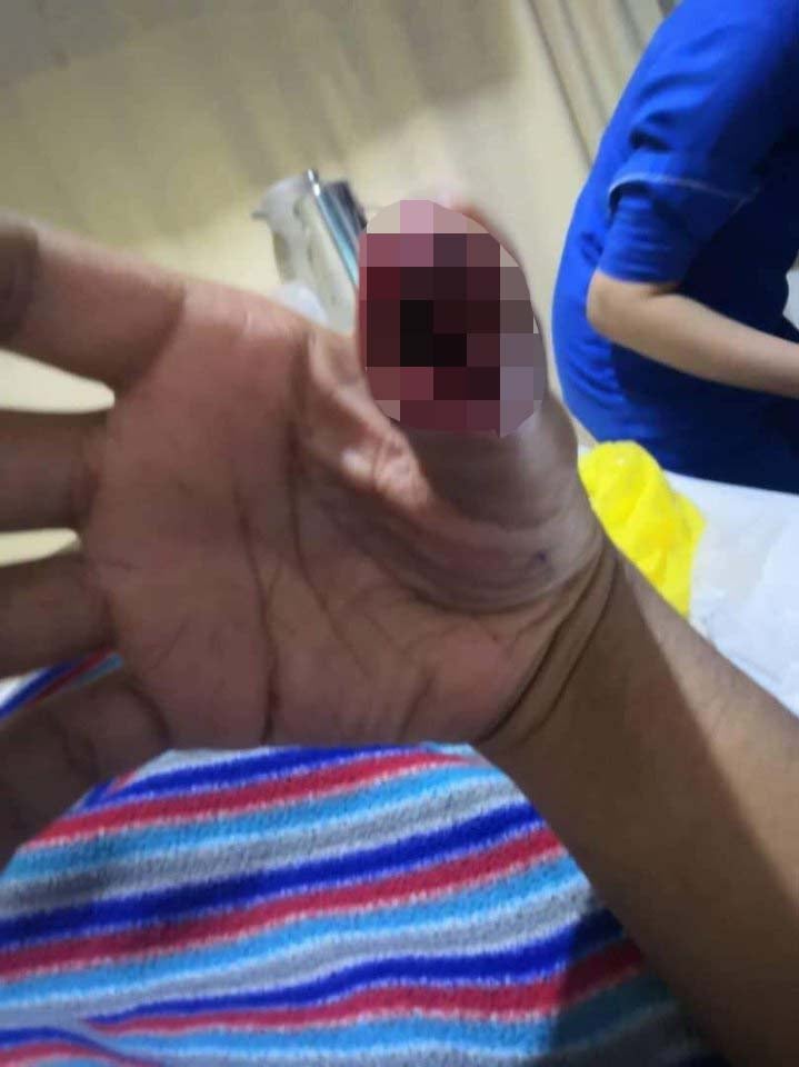Young Man's Thumb Got Swollen & Infected After He Unknowingly Cut It On Cracked Screen Protector - WORLD OF BUZZ 1