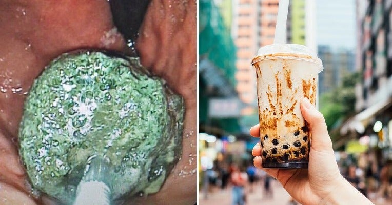 20Yo Man Drinks Bubble Tea 3 Times A Day, Ends Up With Severe Tapioca Blockage In Intestines - World Of Buzz 2