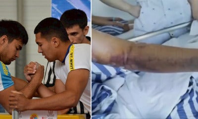 21Yo College Student Fractures Arm &Amp; Loses Control Of It After Arm-Wrestling With Friend - World Of Buzz 1