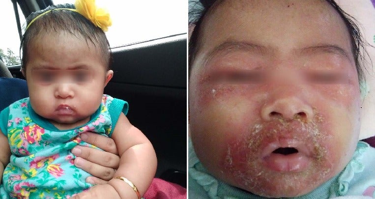 5-Month-Old Baby Gets Swollen & Painful Face After Contracting Severe Skin Infection From Being Held By Others - WORLD OF BUZZ
