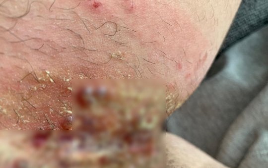 Man suffered groin blisters, severe burns after leaving hair