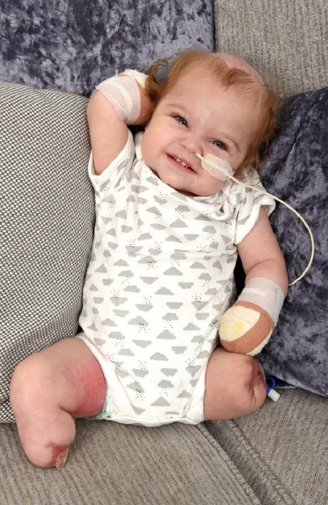 Baby Develops Sepsis From Throat Infection, All Limbs Amputated - WORLD OF BUZZ 1
