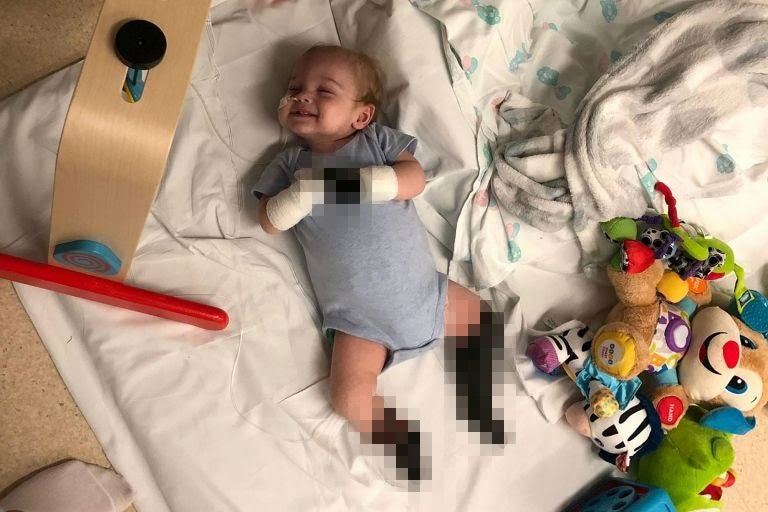 Baby Develops Sepsis From Throat Infection, All Limbs Amputated - WORLD OF BUZZ 6