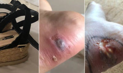23Yo Woman Almost Dies After Getting Blood Infection From Blister Caused By Shoe Strap - World Of Buzz