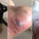 23Yo Woman Almost Dies After Getting Blood Infection From Blister Caused By Shoe Strap - World Of Buzz