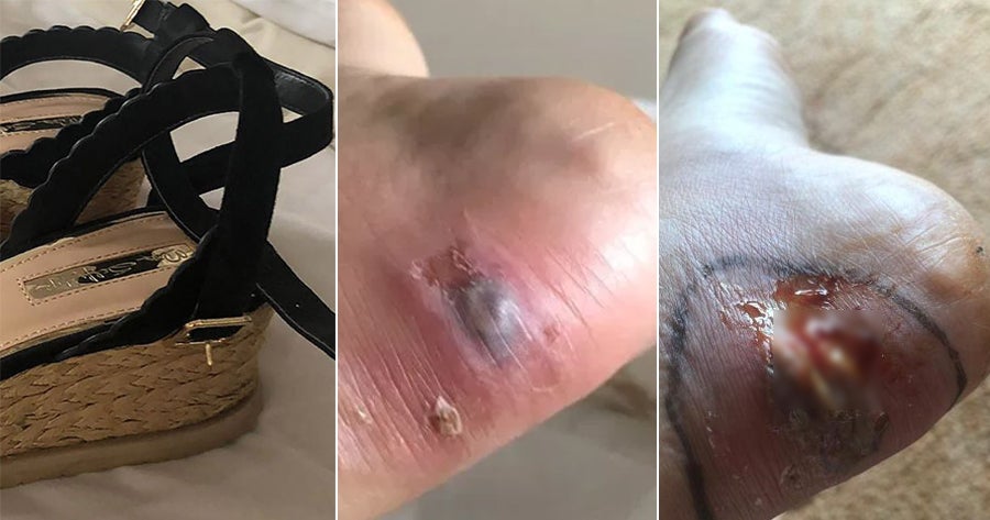 23yo Woman Almost Dies After Getting Blood Infection From Blister Caused By Shoe Strap - WORLD OF BUZZ
