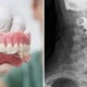 Elderly Man'S Dentures Got Stuck In Throat During Surgery, Doctors Only Noticed It 8 Days Later - World Of Buzz 3