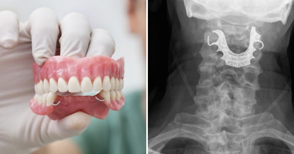 Elderly Man'S Dentures Got Stuck In Throat During Surgery, Doctors Only Noticed It 8 Days Later - World Of Buzz 3