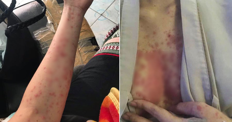 Woman Develops Severe Rash Due To An Imbalanced Immune Sys - World Of Buzz