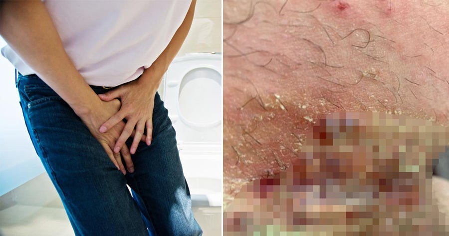 Man Left With Large &Amp; Blistering Open Wounds On His Groin After Leaving Hair Removal Cream For T - World Of Buzz