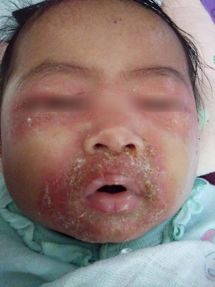 M'sian Mother Shares How Baby Contracted Severe Skin Infection From Being Held By Others - WORLD OF BUZZ 2