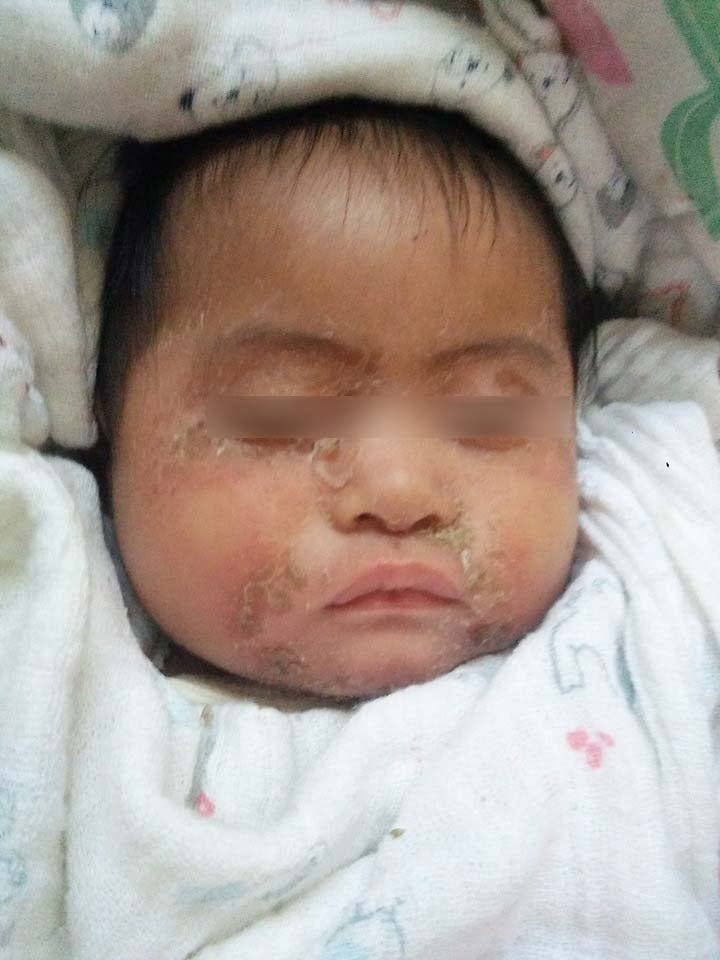 M'sian Mother Shares How Baby Contracted Severe Skin Infection From Being Held By Others - WORLD OF BUZZ 3