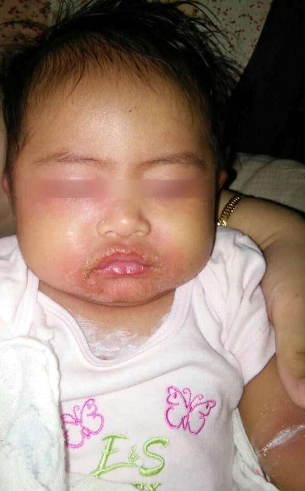 M'sian Mother Shares How Baby Contracted Severe Skin Infection From Being Held By Others - WORLD OF BUZZ