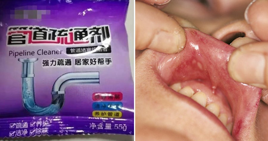 2Yo Boy Eats Pipe Cleaning Powder So Mum Flushes Mouth With Water But Burns Him Instead - World Of Buzz