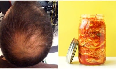 Study: Kimchi May Reverse Hair Loss, Scientists Say It Could Be A Cure For Baldness - World Of Buzz
