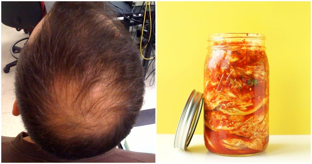 Study: Kimchi May Reverse Hair Loss, Scientists Say It Could Be A Cure For Baldness - WORLD OF BUZZ