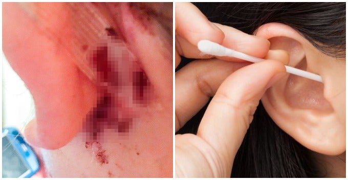 Woman Warns Others About Using Cotton Buds To Clean Ears After She Contracted Deadly Brain Infection - World Of Buzz 1