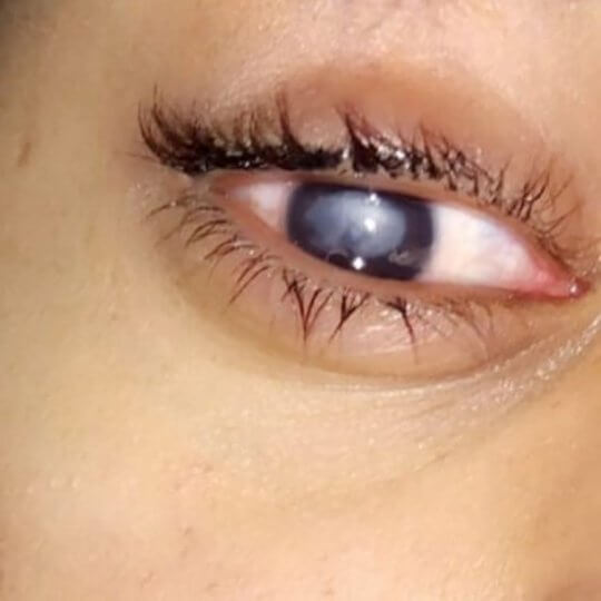 20yo Student Wears Contact Lens While Swimming in The Sea, Goes Blind After Getting Eye Infection - WORLD OF BUZZ 2