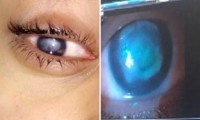 20Yo Student Wears Contact Lens While Swimming In The Sea, Goes Blind After Getting Eye Infection - World Of Buzz 4