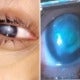 20Yo Student Wears Contact Lens While Swimming In The Sea, Goes Blind After Getting Eye Infection - World Of Buzz 4