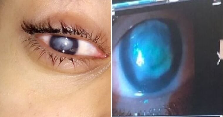 20yo Student Wears Contact Lens While Swimming in The Sea, Goes Blind After Getting Eye Infection - WORLD OF BUZZ 4