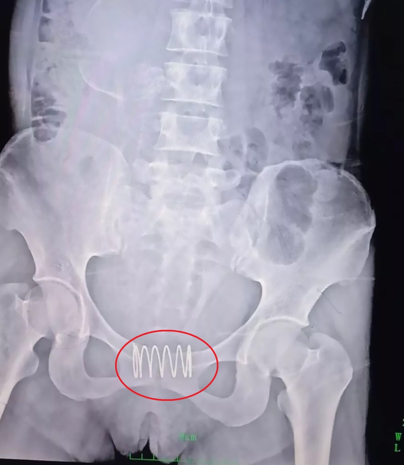 31yo Mother Inserts Metal Spring Into Her Vagina So That She Wouldn't Get Pregnant - WORLD OF BUZZ 3