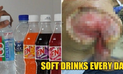 56Yo M'Sian Man Drank Soft Drinks Every Day, Gets Blistering Skin Infection &Amp; Almost Loses His Arm - World Of Buzz