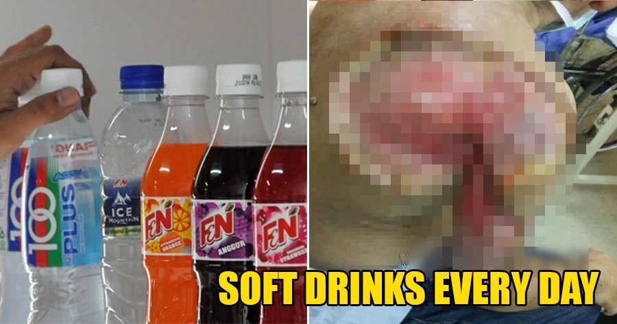 56Yo M'Sian Man Drank Soft Drinks Every Day, Gets Blistering Skin Infection &Amp; Almost Loses His Arm - World Of Buzz