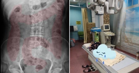 doctor discovers 11yo malaysians intestines filled with poop likely due to habit of not eating vegetables world of buzz 3 e1567497496768