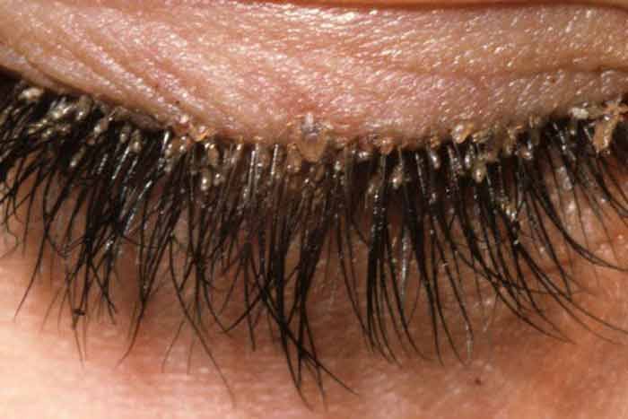 eyelash mites causes symptoms get rid treat