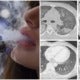 5 Dead From Vape-Related Illnesses, 450 Cases Reported; Experts Caution Against Using E-Cigarettes - World Of Buzz
