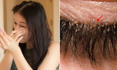32Yo Woman Did Not Remove Makeup Properly Found Mites In Her Eyelashes After Having Itchy &Amp; Dry Eyes - World Of Buzz