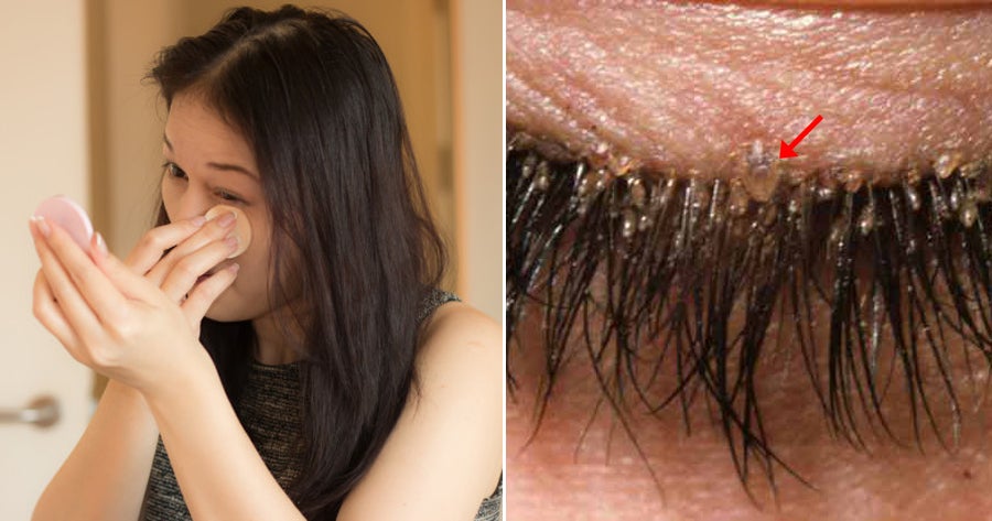 32yo Woman Did Not Remove Makeup Properly Found Mites in Her Eyelashes After Having Itchy & Dry Eyes - WORLD OF BUZZ