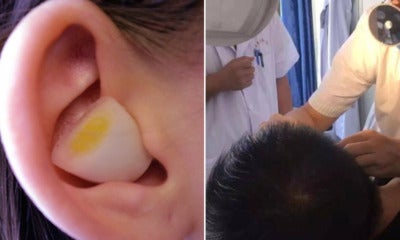 Man Couldn'T Sleep At Night So He Stuffs Raw Garlic Into Ear, Gets Stuck As It Was Too Deep - World Of Buzz
