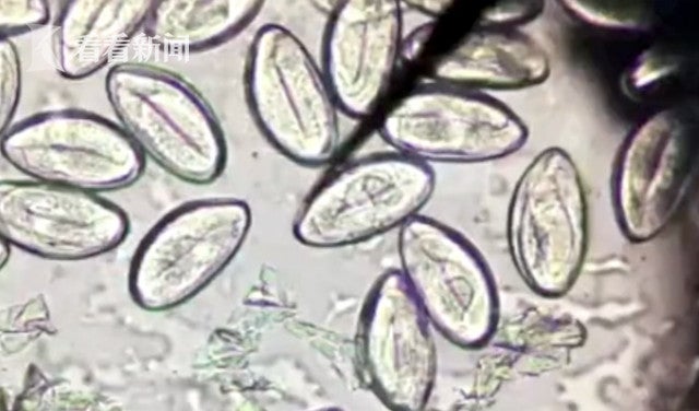 Man's Liver Gets Infected with Parasitic Worms After He Ate Raw Seafood for 3 Years - WORLD OF BUZZ 1