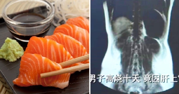 mans liver gets infected with parasitic worms after he ate raw seafood for 3 years world of buzz 3 1