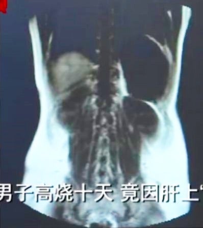 Man's Liver Gets Infected with Parasitic Worms After He Ate Raw Seafood for 3 Years - WORLD OF BUZZ