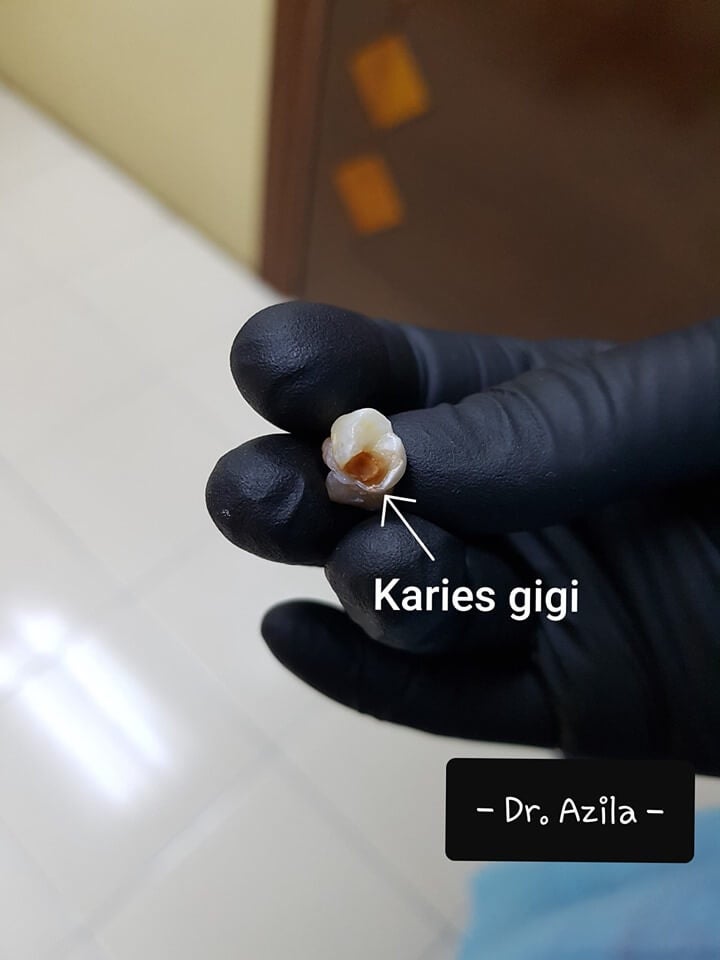 M'sian Dentist Warns Parents After 5yo Girl Almost Died From Tooth Cavities Caused By Overeating Sugary Food - WORLD OF BUZZ