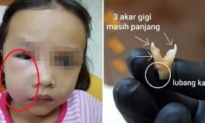 M'Sian Dentist Warns Parents After 5Yo Girl Almost Died From Tooth Cavities Due To Overeating Sweets - World Of Buzz
