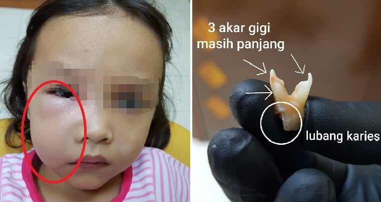 M'sian Dentist Warns Parents After 5yo Girl Almost Died From Tooth Cavities Due to Overeating Sweets - WORLD OF BUZZ
