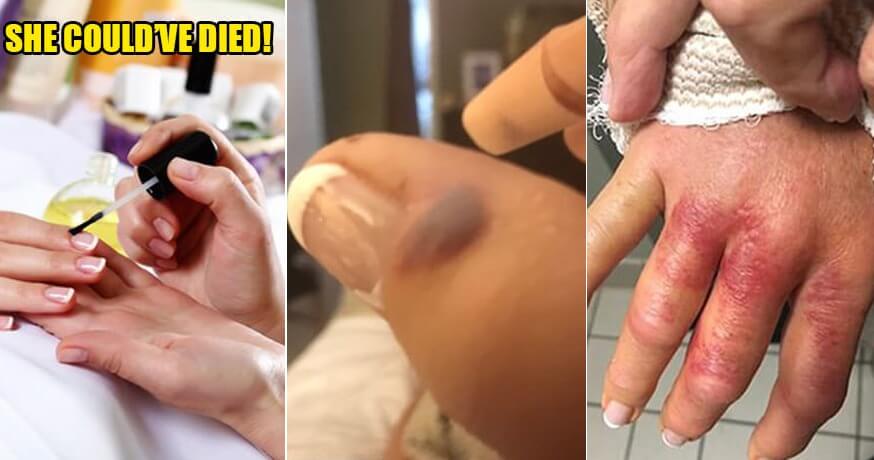 Woman Almost Loses Hand When Flesh-Eating Bacteria Entered Her Thumb After Getting Manicure - World Of Buzz 1