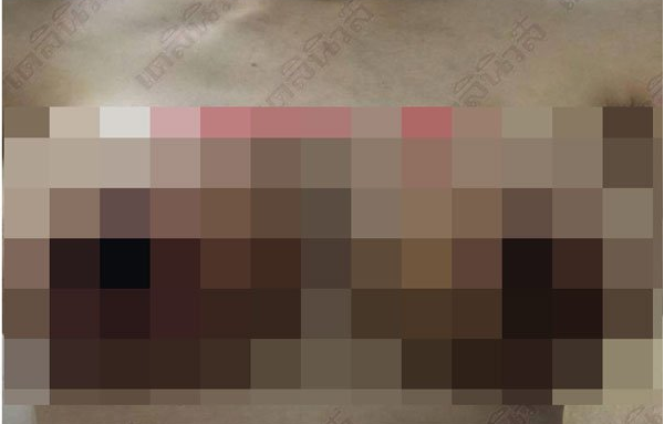 Woman Pays RM9,590 For Breast Surgery That Made Her Lose Her Nipples - WORLD OF BUZZ 2
