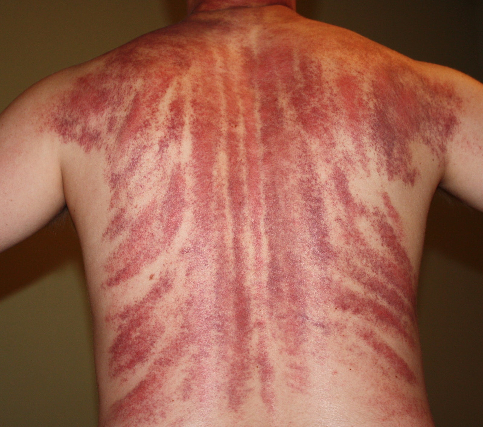 36yo Man Suffers From A Sudden Stroke After Going For Gua Sha Massage Treatment - WORLD OF BUZZ