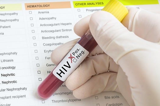 HIV Positive Test