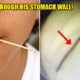 69Yo Man Had A Toothpick In His Stomach That Pierced Through His P - World Of Buzz