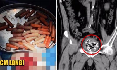 69Yo Man Inserts 47 Plastic Tubes So Far Into His Penis That It Crammed Into His Bladder - World Of Buzz