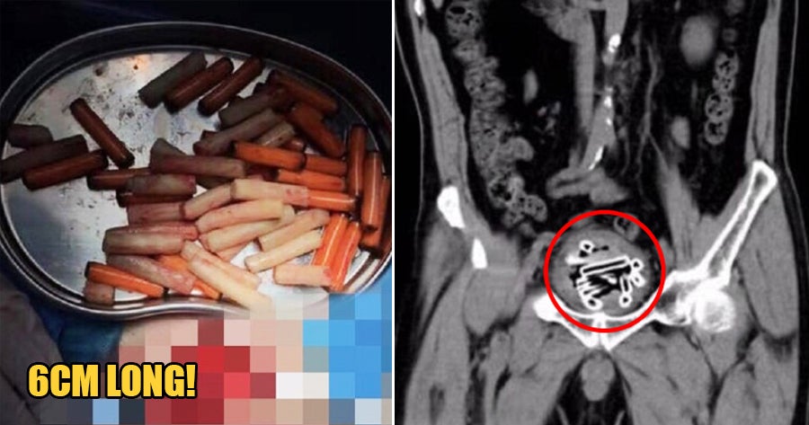 69yo Man Inserts 47 Plastic Tubes So Far Into His Penis That It Crammed Into His Bladder - WORLD OF BUZZ