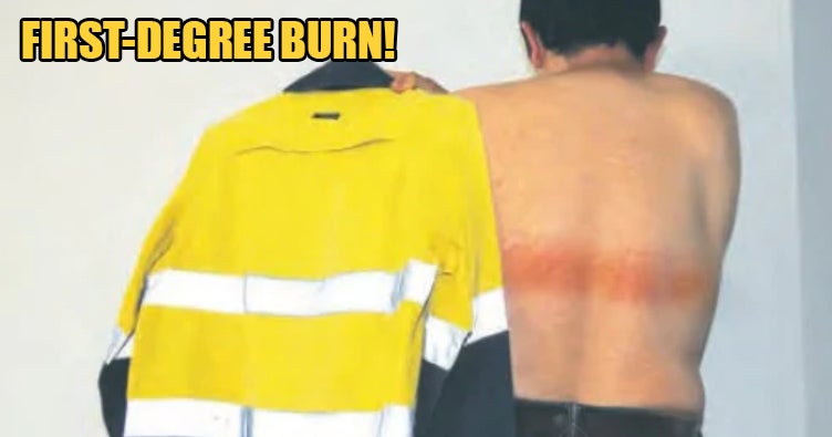 40Yo Suffers First-Degree Burns On His Back After Reflective Strip On Shirt Becomes Too Hot - World Of Buzz