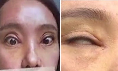 Woman Can'T Close Her Eyes Fully After Getting Double Eyelid Surgery Twice - World Of Buzz