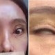 Woman Can'T Close Her Eyes Fully After Getting Double Eyelid Surgery Twice - World Of Buzz